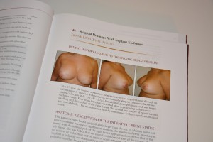 breast-augmentation-revision