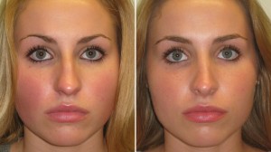 before-after-nose-reshaping