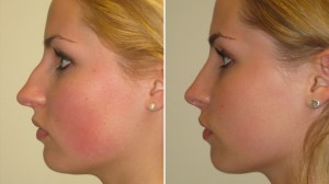 before-after-rhinoplasty-photo