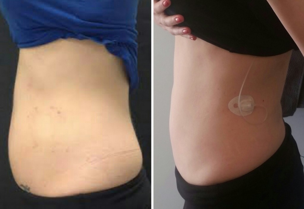 before-after-CoolSculpting-Toronto