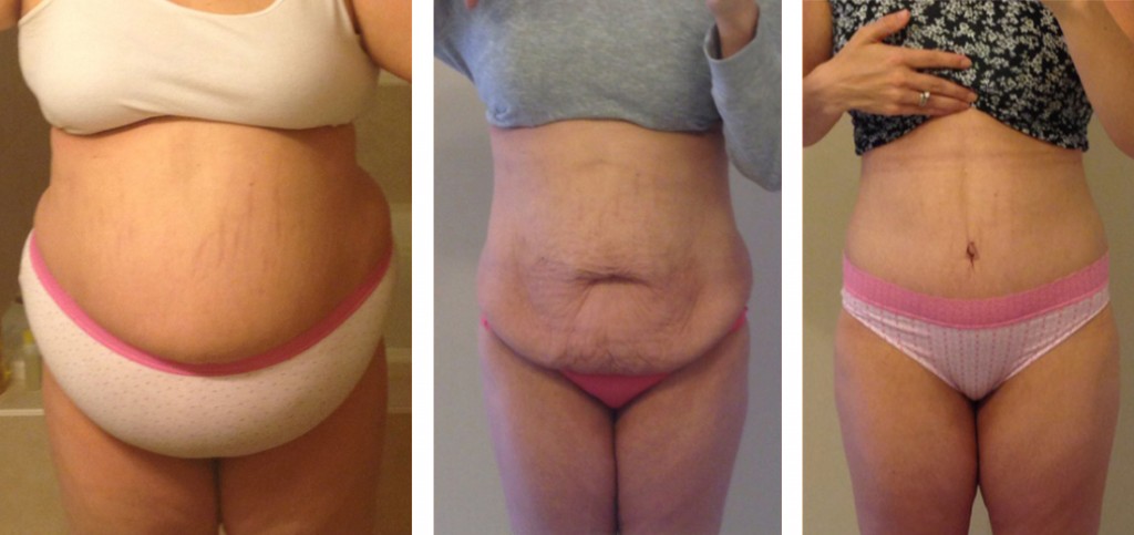 tummy-tuck-after-significant-weight-loss