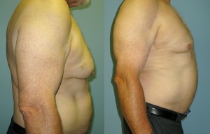 Gynecomastia correction