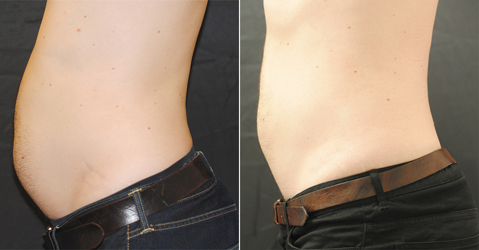 CoolSculpting before and after photo