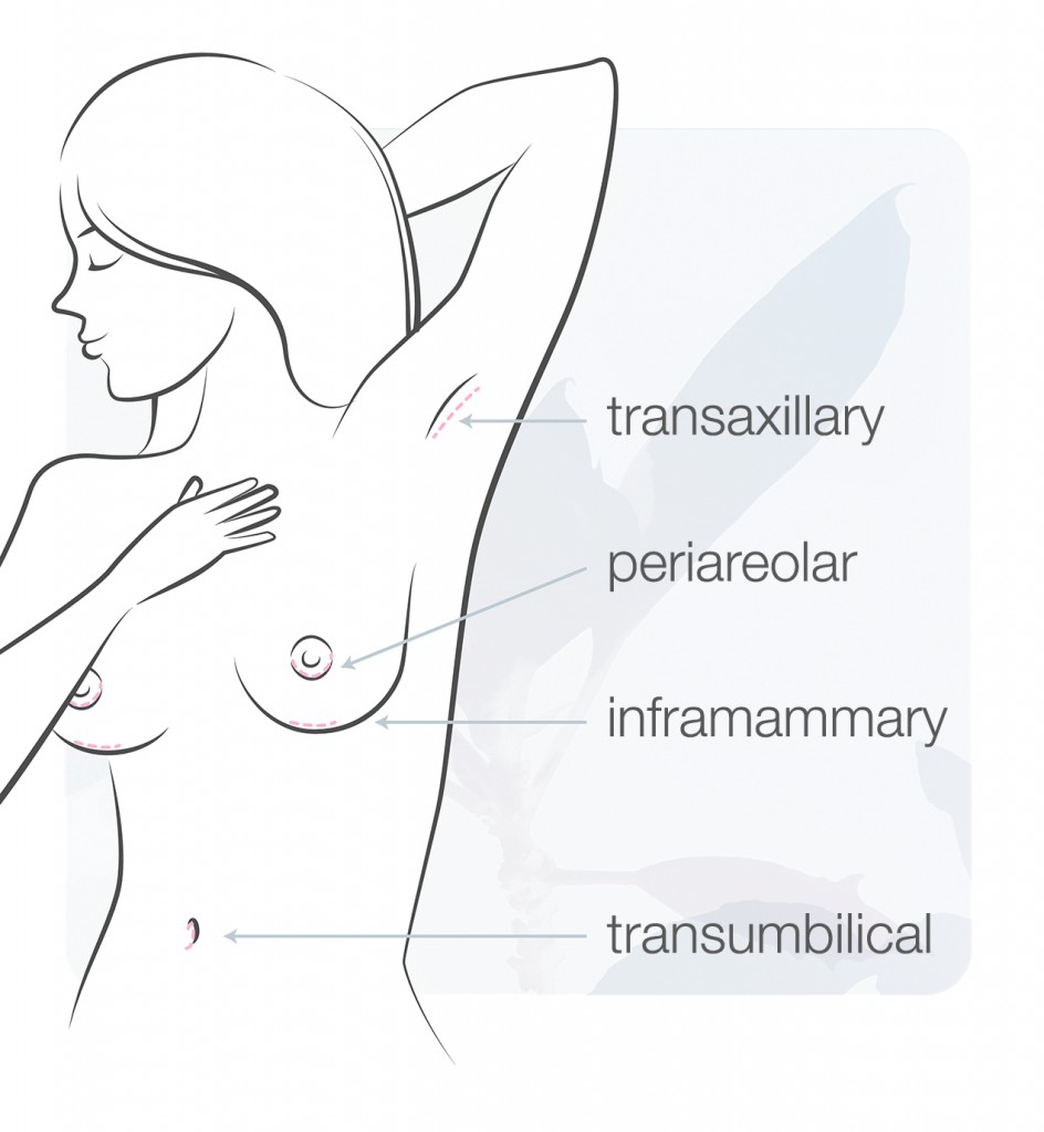 incision placement for breast augmentation