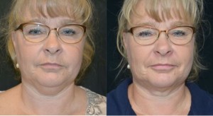 coolsculpting-for-double-chin