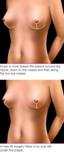 Breast Lift Procedure