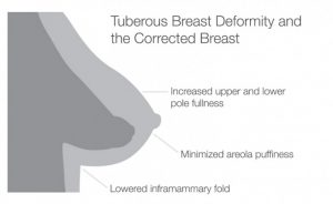 Breast Augmentation and Tuberous Breast Deformity