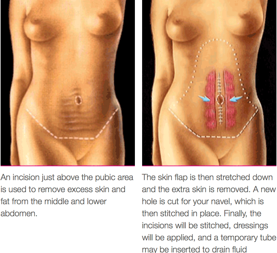 Tummy Tuck Procedure Diagram