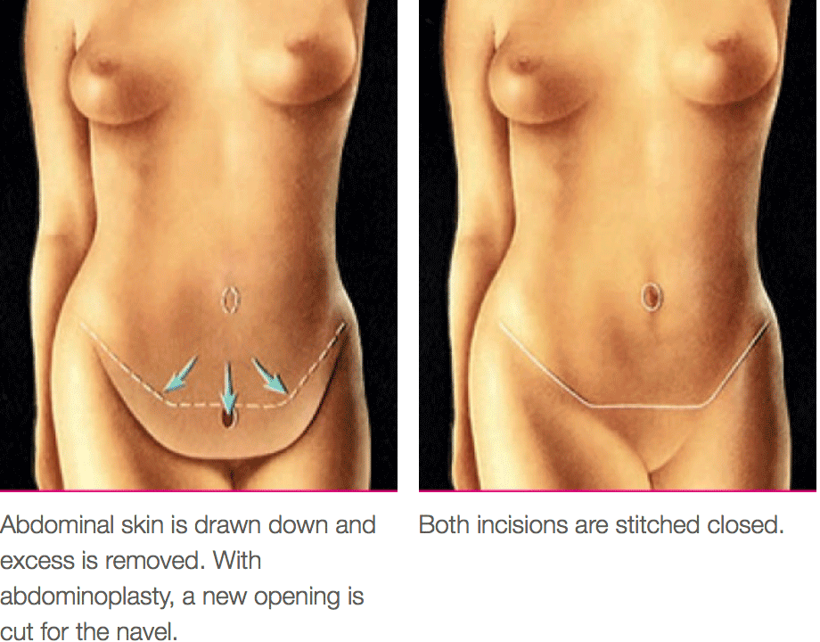 Tummy Tuck (Abdominoplasty) Mississauga Toronto ON