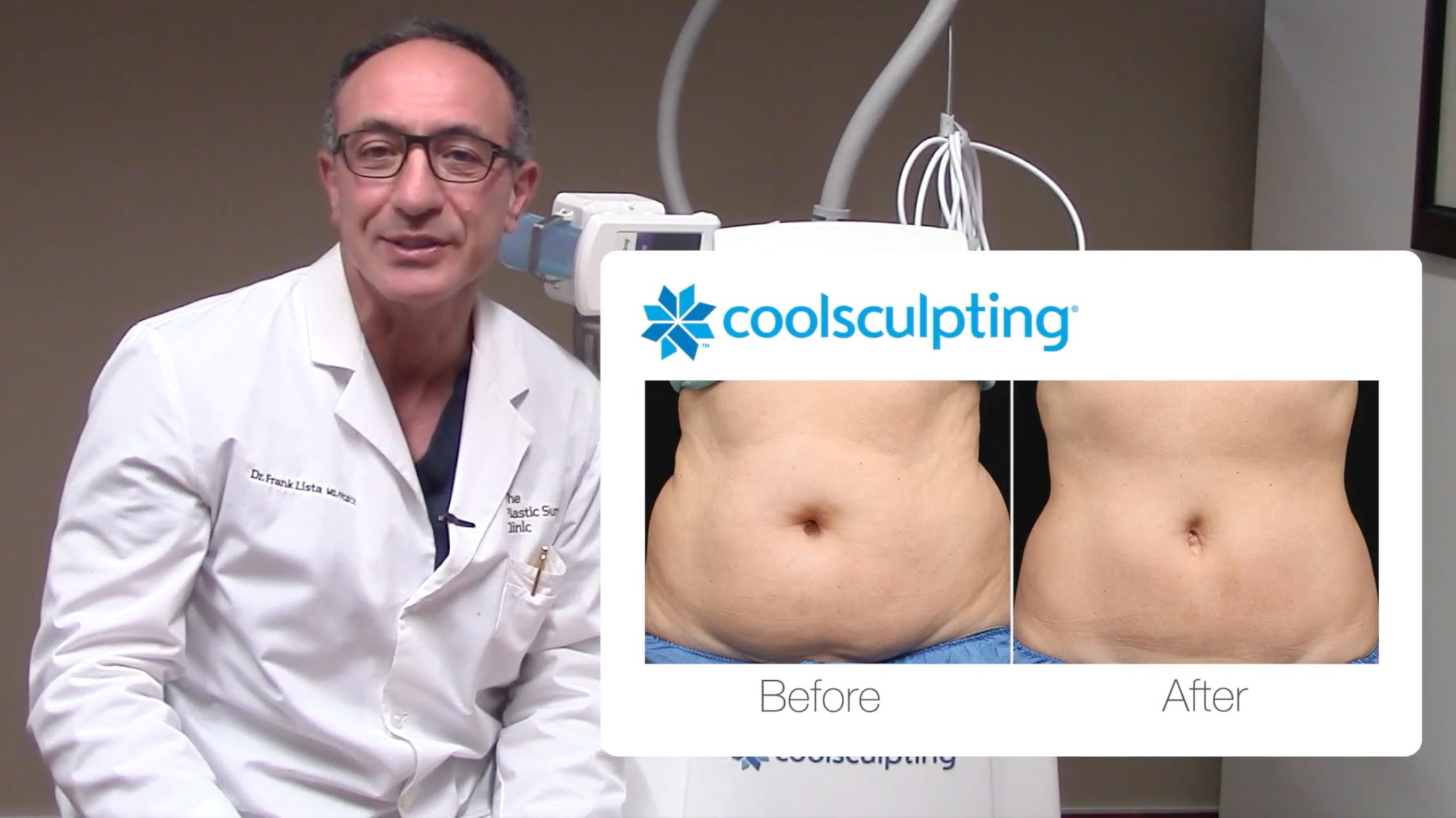 Dr. Lista on CoolSculpting