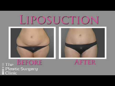 Dr. Lista on Liposuction