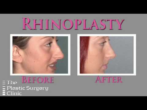 Dr. Lista on Rhinoplasty