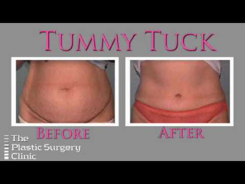 Dr. Lista on the Tummy Tuck Procedure