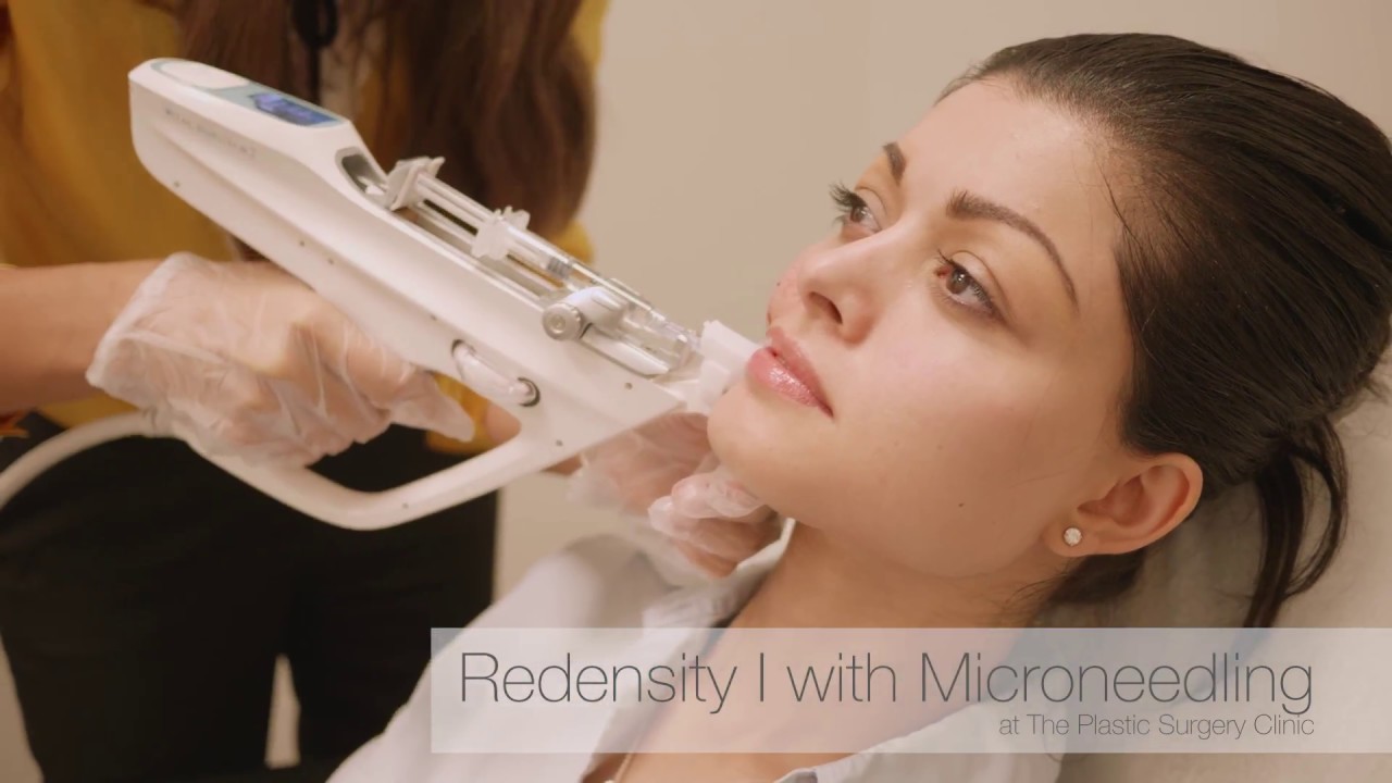 Redensity I: The Newest Skin Rejuvenating Treatment