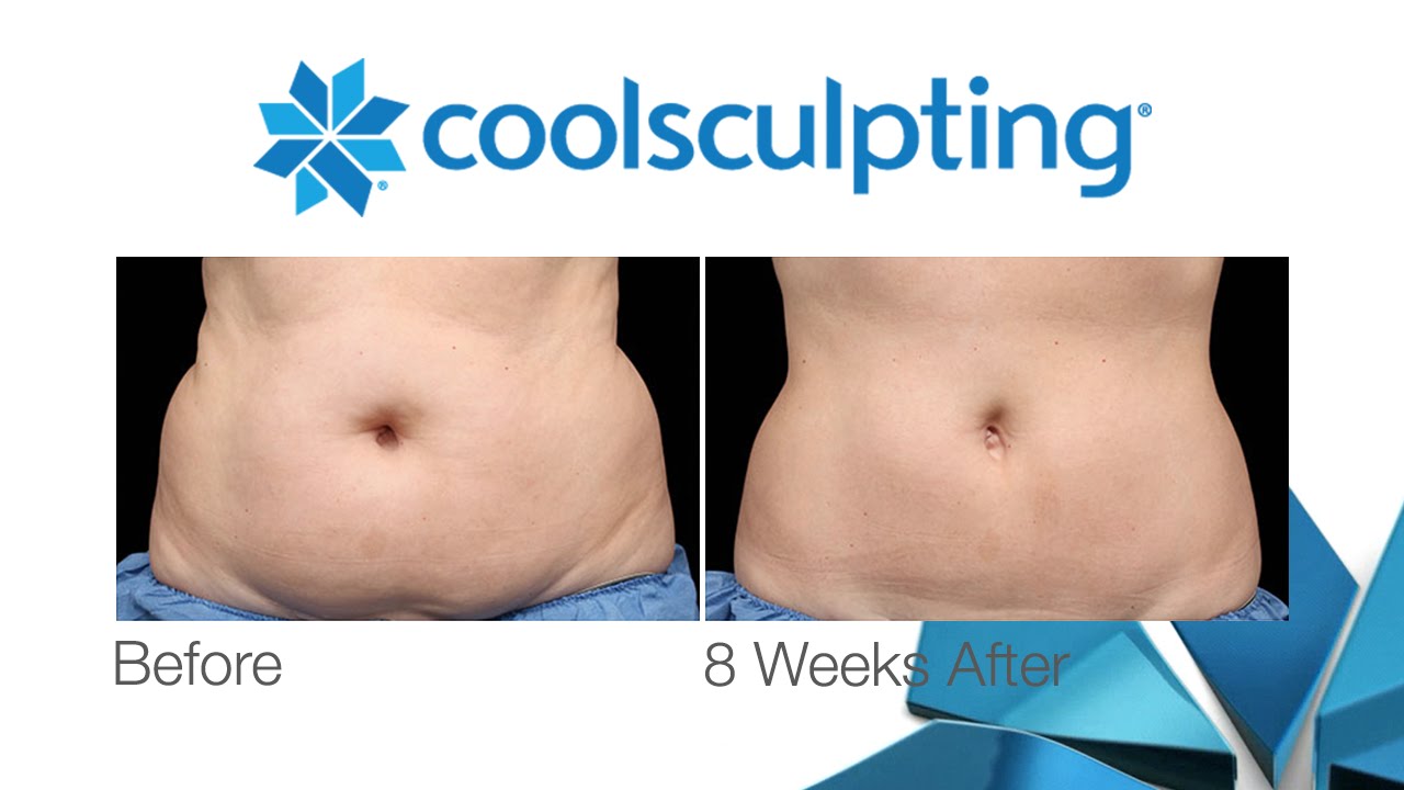 What is CoolSculpting?