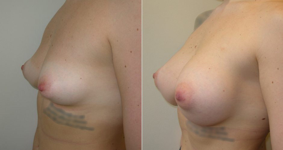 Breast Augmentation Before & After Photo