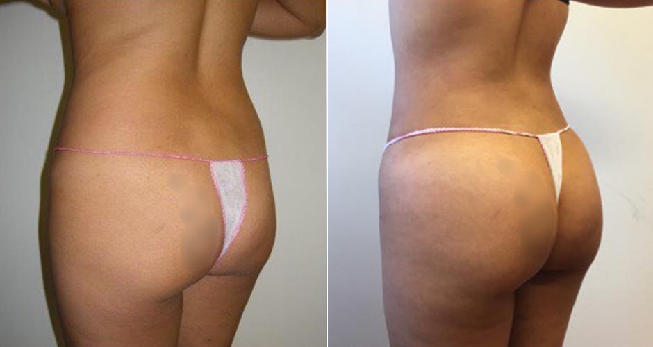 Brazilian Butt Lift  Lipoaesthetic Female