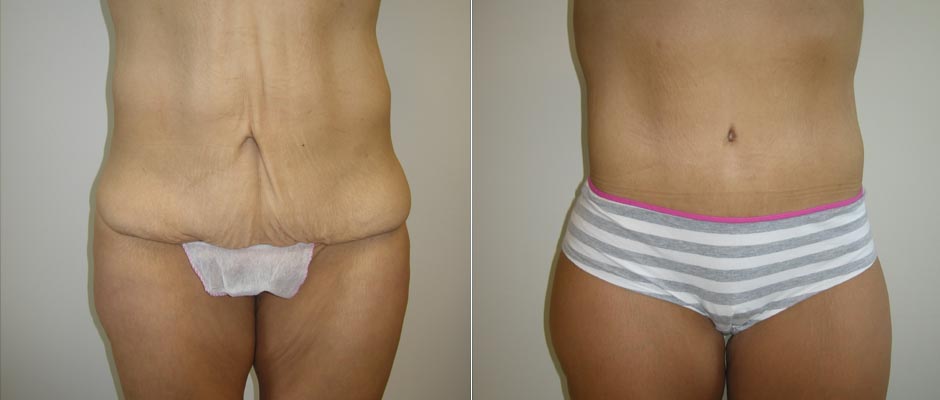 Body Contouring Before & After Photos
