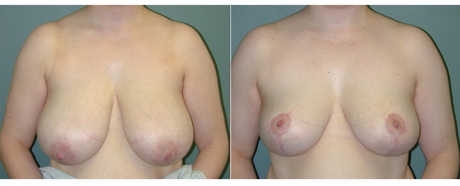 Breast reduction patient before and after