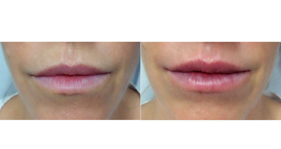 Lip Injection Before and After