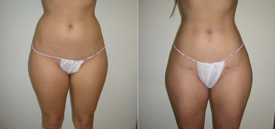 Surgical Body Contouring In Depth: Procedures, Recovery & More