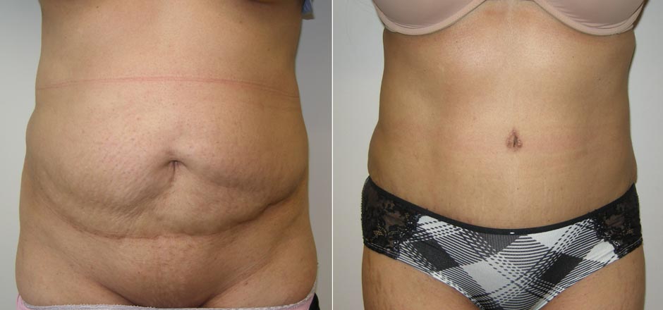 Tummy Tuck (Abdominoplasty) Mississauga Toronto ON