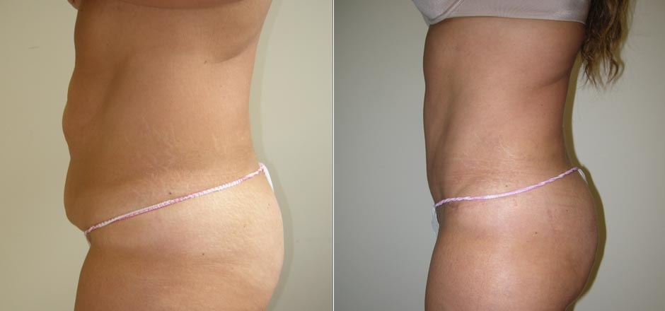 Tummy Tuck: Procedure Info, Pics, Cost & More