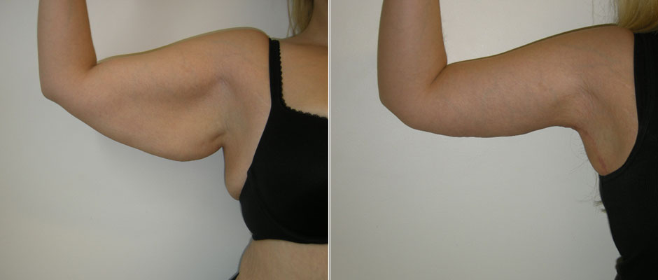 Arm Lift Before & After Photo