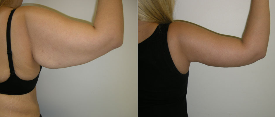 Cosmetic Arm Lift: Procedure, Preparation, Outcomes and More