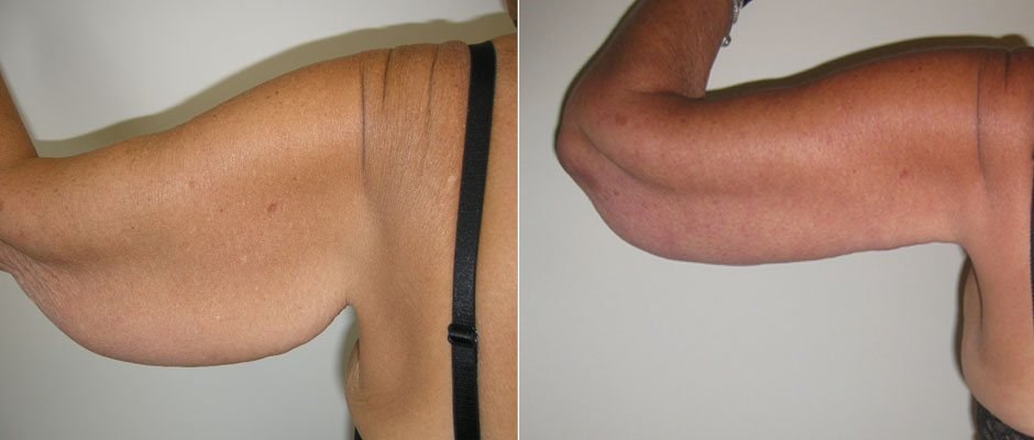 Arm Lift Before & After Photo