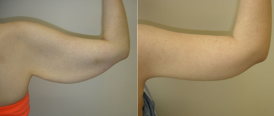 Arm Lift Before & After Photo