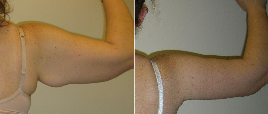 Arm Lift Before & After Photo