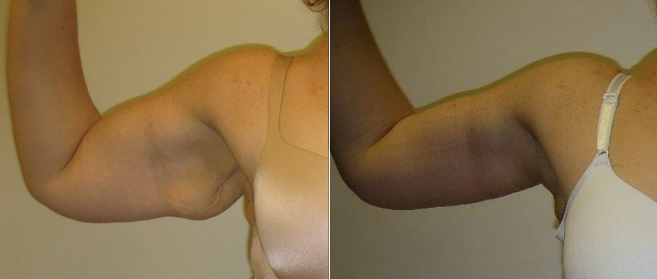 Arm Lift Before & After Photo