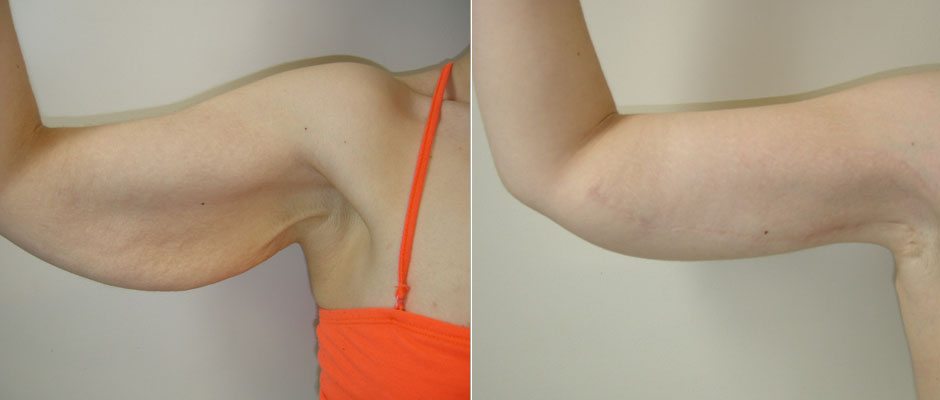 Body Contouring Before & After Photo