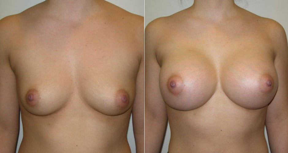 Breast Augmentation Before & After Photo