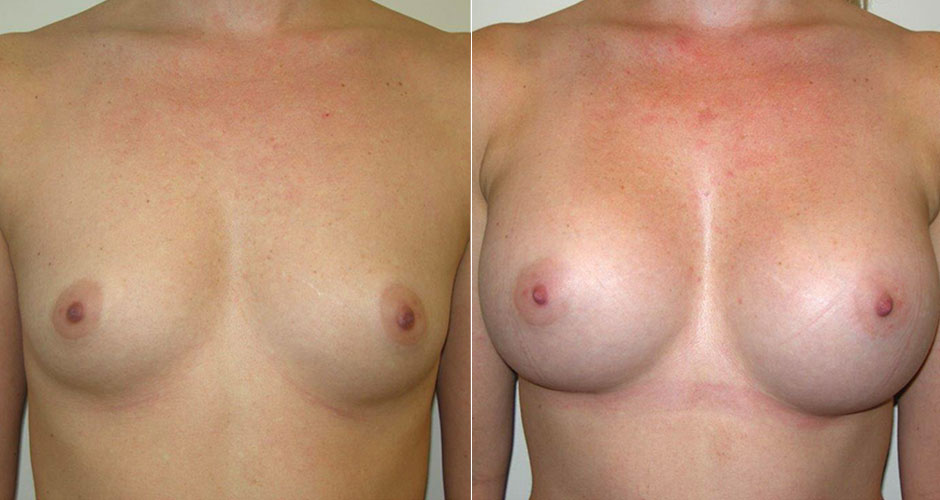 Breast Augmentation Before & After Photo