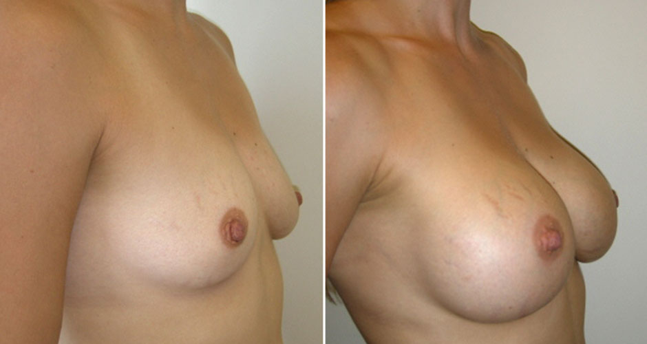 Breast Augmentation Before & After Photo