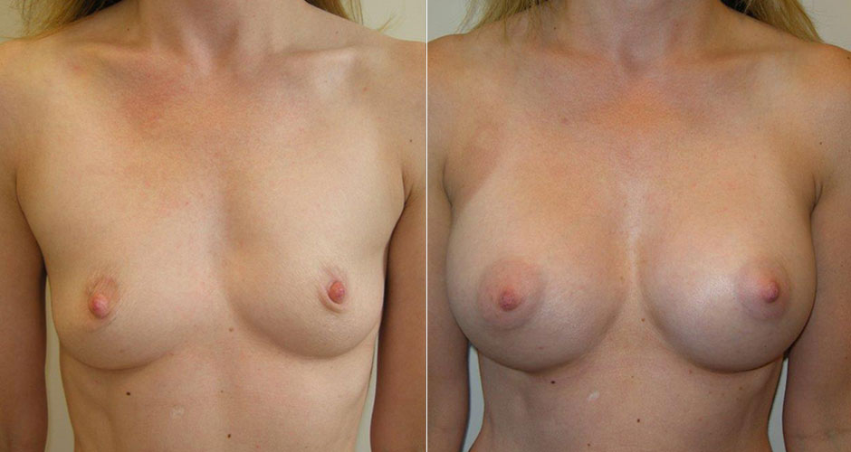 Breast Augmentation Before & After Photo