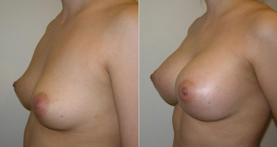 Breast Augmentation Before & After Photo