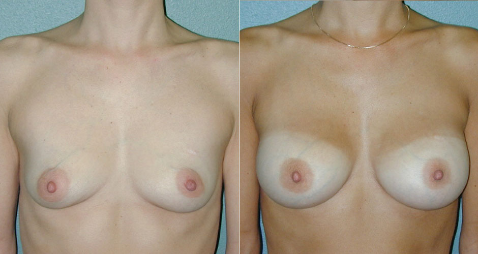 Breast Augmentation Before & After Photo