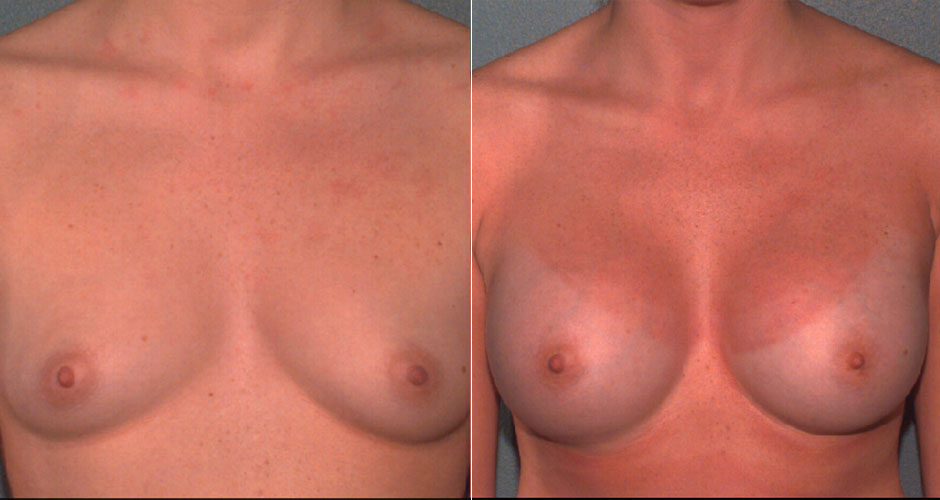 Breast Augmentation Before & After Photo