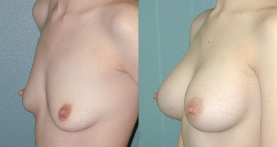 Breast Augmentation Before & After Photo