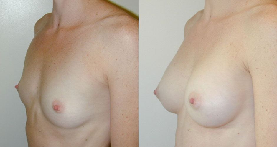 Breast Augmentation Before & After Photo