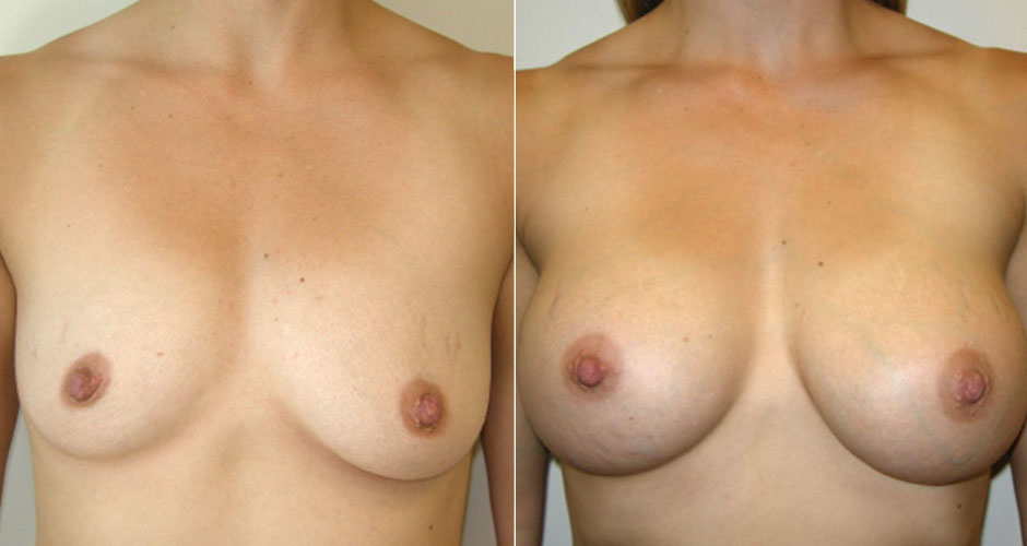 Breast Augmentation Before & After Photo