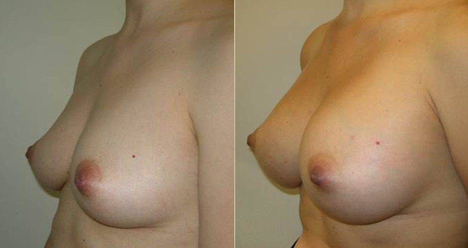Breast Augmentation Before & After Photo