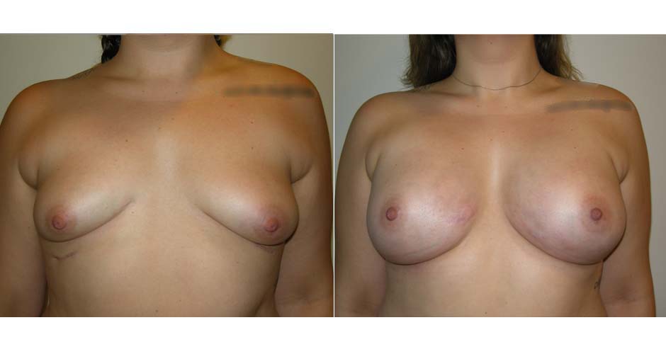 Breast Augmentation Before & After Photo