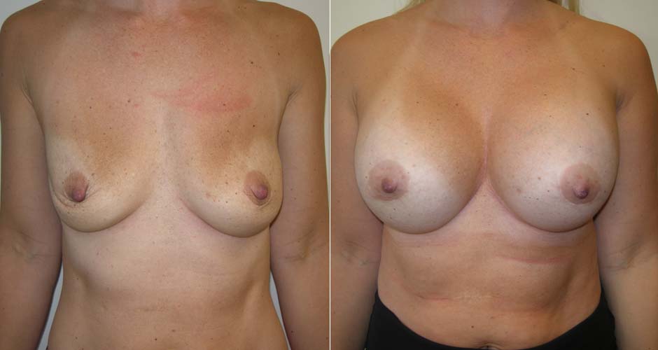 Breast Augmentation Before & After Photo