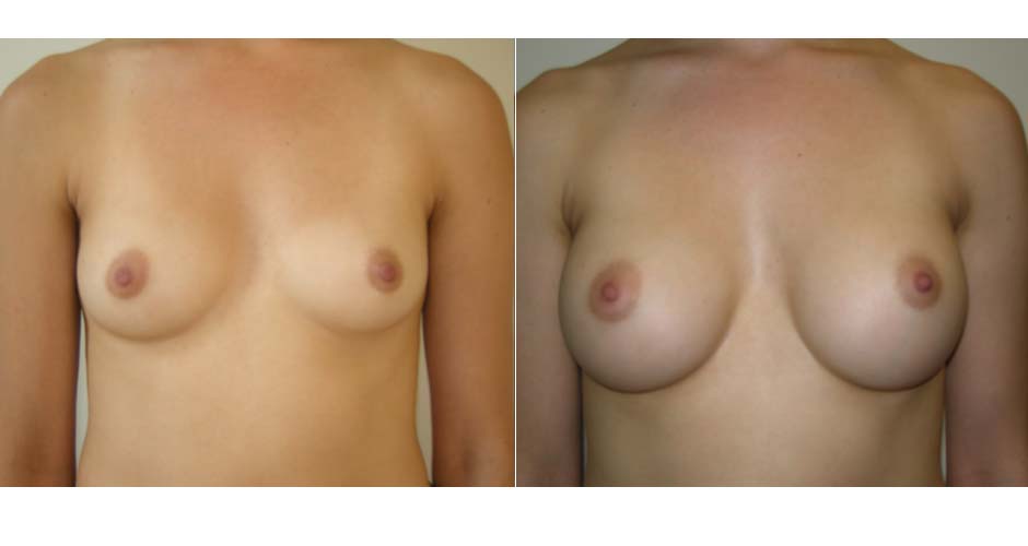 Breast Augmentation Before & After Photo