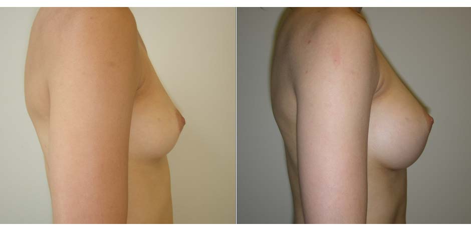 Breast Augmentation Before & After Photo