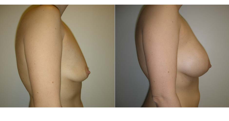 Breast Augmentation Before & After Photo